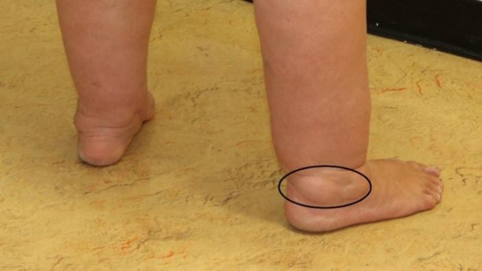 Example of lipoedema ankle swelling