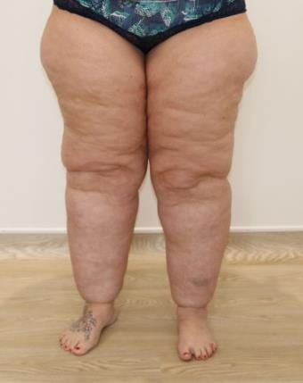 Lipoedema lower limb example - posterior view