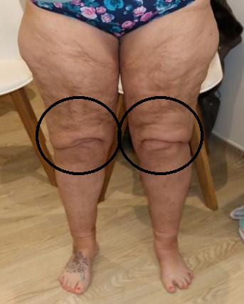 Lipoedema lower limb example - anterior view