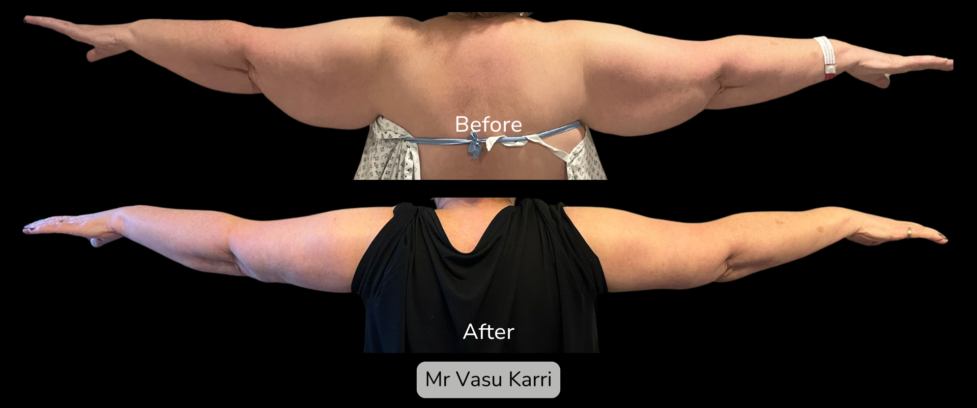 Arm Lift in Rotherham Before & After 1