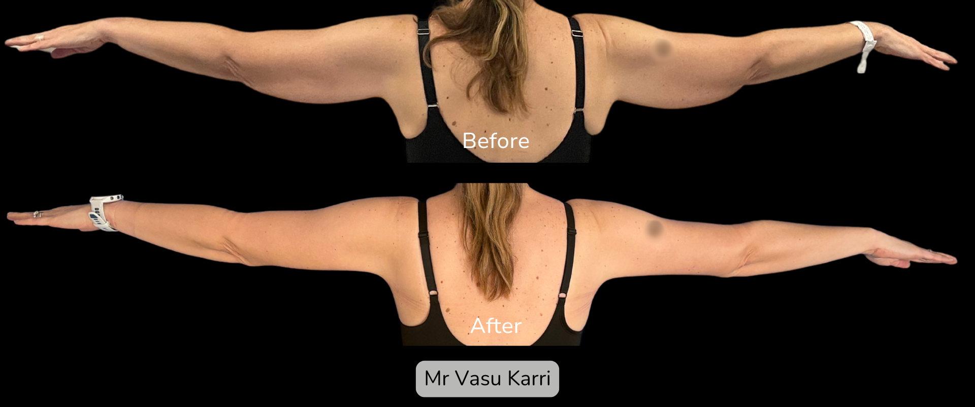 Arm Lift in Rotherham Before & After 3