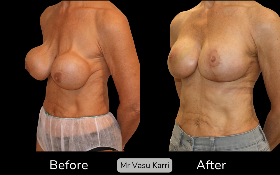 Breast Capsular Contracture Surgery in Rotherham Before & After 3