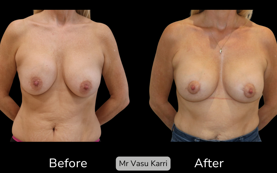 Breast Capsular Contracture Surgery in Rotherham Before & After 2