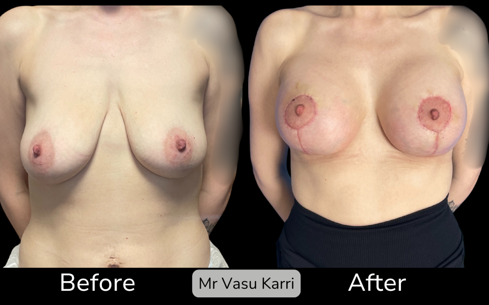Breast Enlargement & Lift in Rotherham Before & After 1