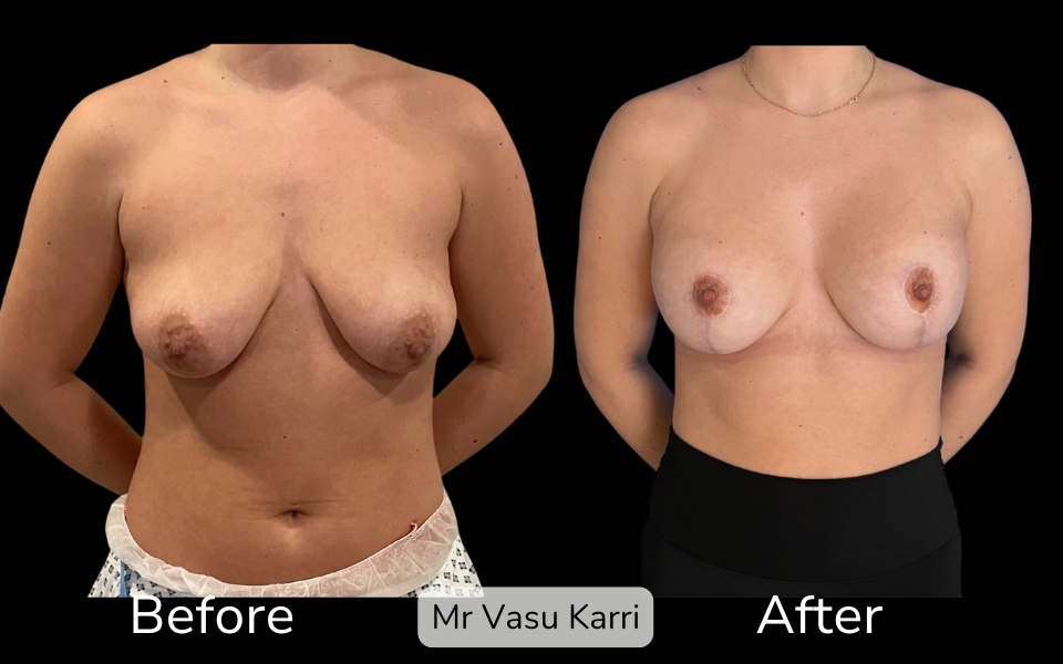 Breast Enlargement & Lift in Rotherham Before & After 2
