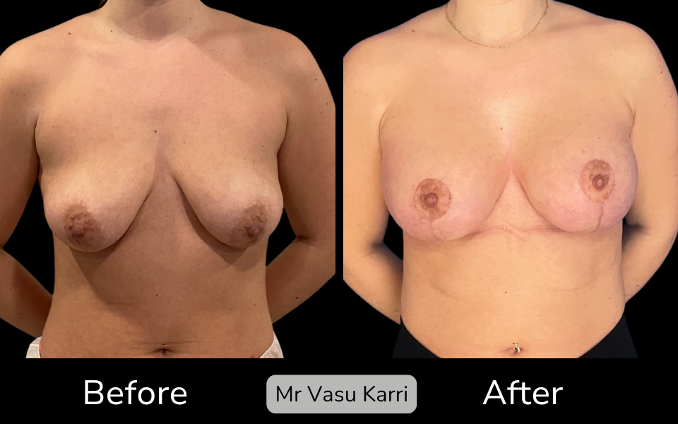 Breast Enlargement & Lift in Rotherham Before & After 3