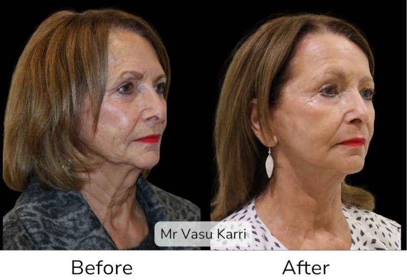 Mini Facelift in Rotherham Before & After 3