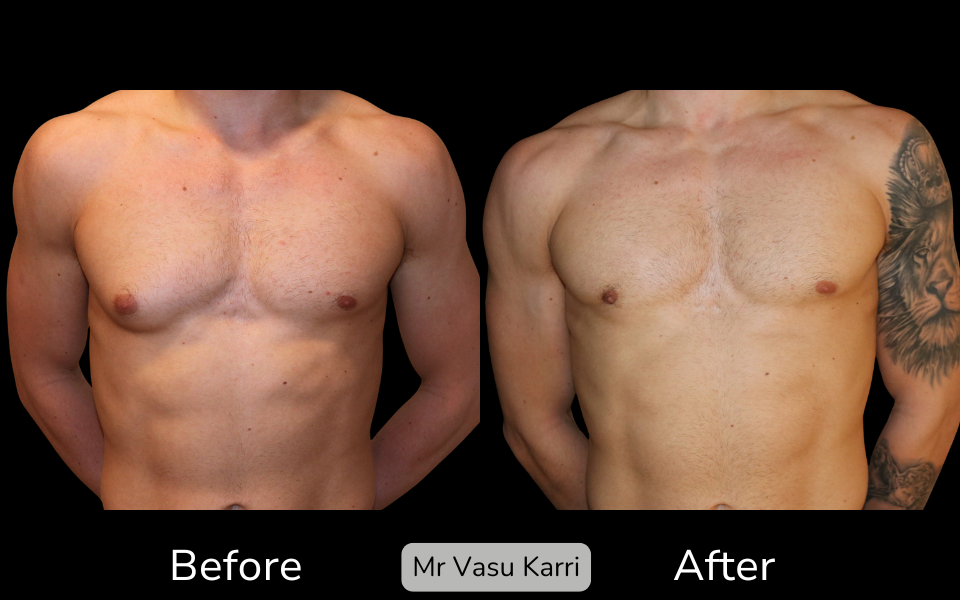 Male Breast Reduction Surgery in Rotherham Before & After 3