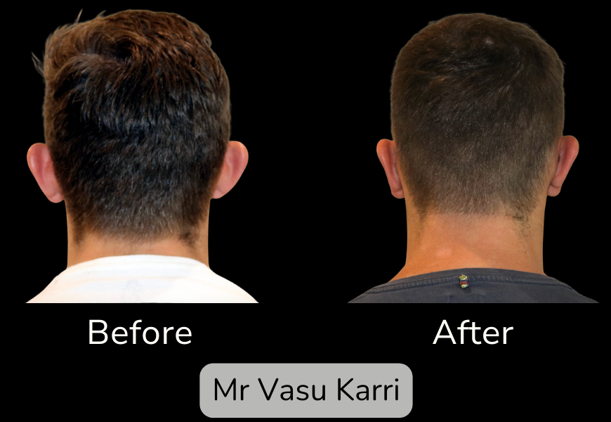 Prominent Ear Correction Surgery in Rotherham Before & After 1