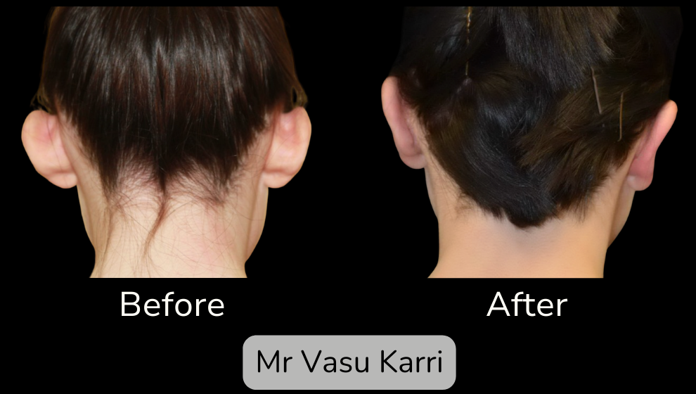 Prominent Ear Correction Surgery in Rotherham Before & After 3