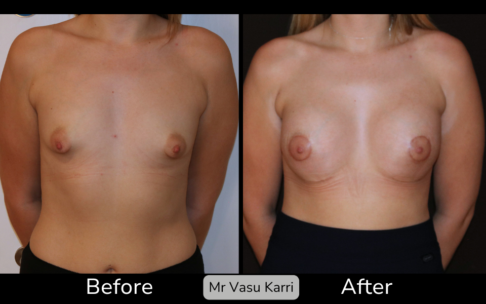 Tuberous Breast Surgery in Rotherham Before & After 2