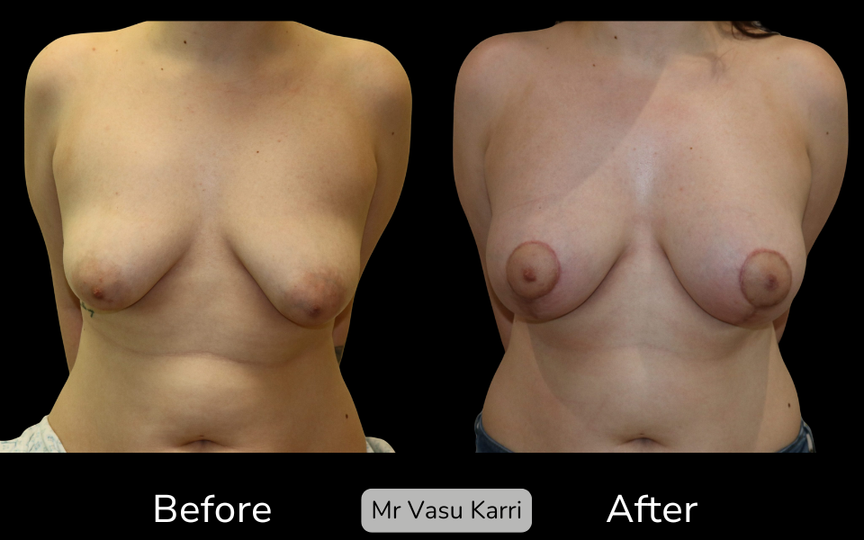 Tuberous Breast Surgery in Rotherham Before & After 3