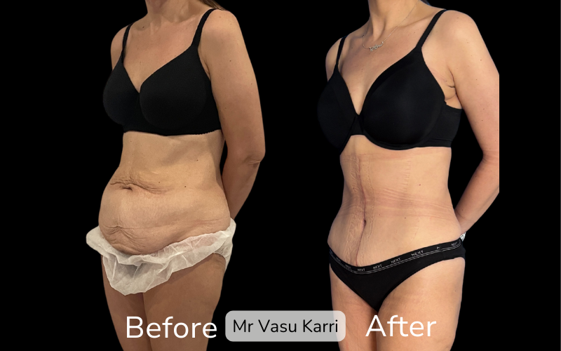 Fleur-de-Lis Tummy Tuck Surgery in Rotherham Before & After 2